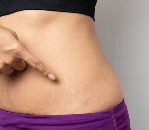 Scar & Stretch Marks Care